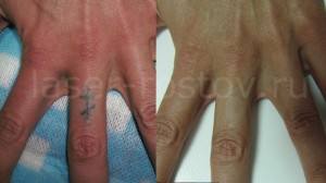 Удаление татуировки на пальцах, на кисти