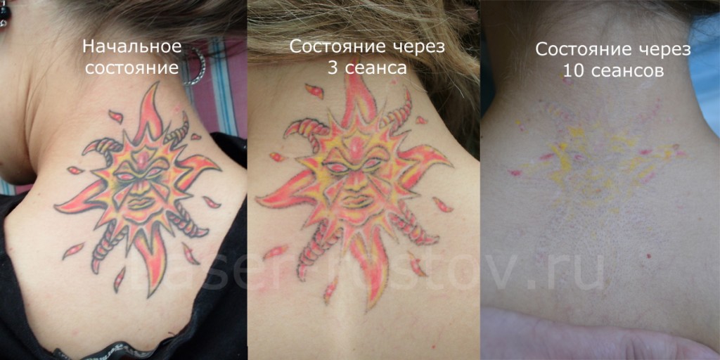 Удаление цветной татуировки лазером