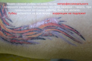 Непрофессиональное удаление татуировки